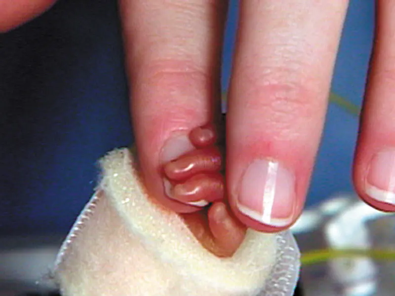 A premature baby's hand holds onto the finger of their parent